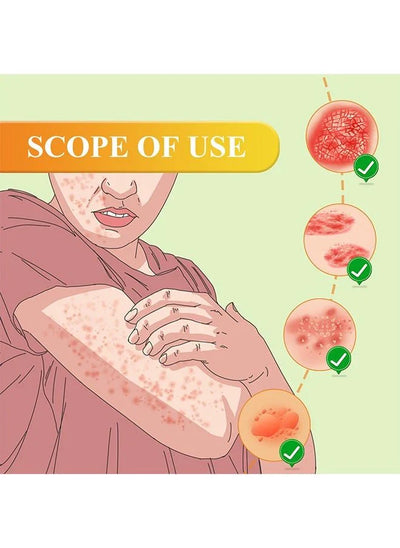 “South Moon - Bee Venom Psoriasis Care Cream (Original)”