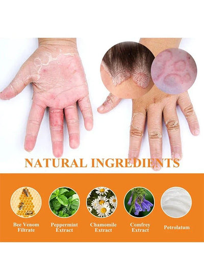 “South Moon - Bee Venom Psoriasis Care Cream (Original)”